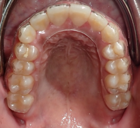 Close-up of the upper dental arch showing teeth and gums with a partial orthodontic retainer.