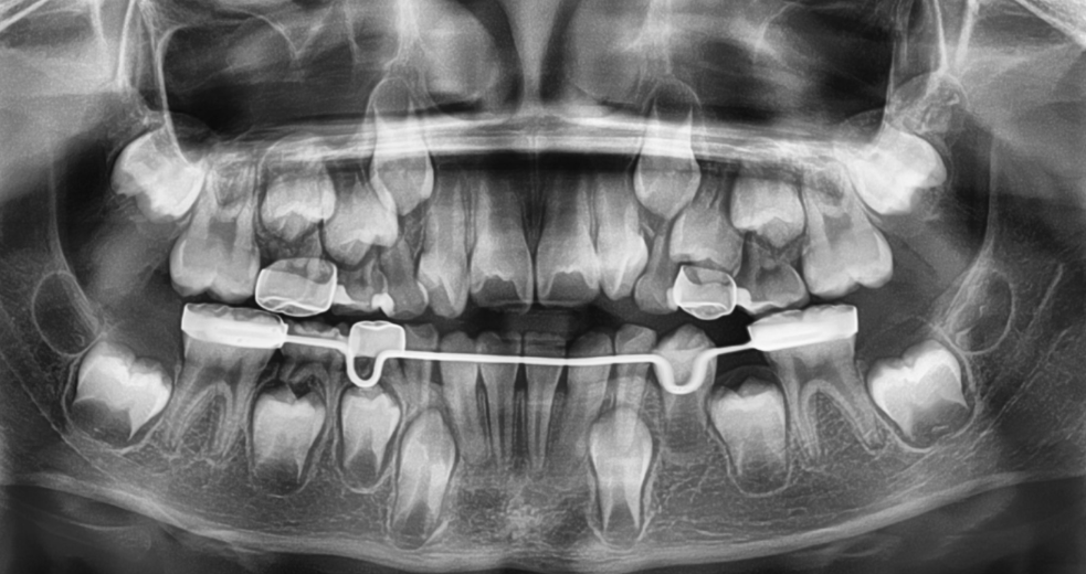Panoramic dental X-ray showing teeth, roots, and braces wire in the lower jaw.