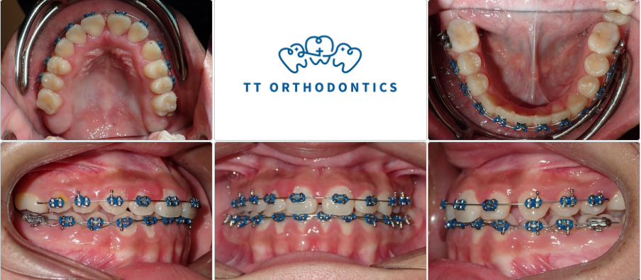 She was a superstar and followed all of the instructions, and all of her crossbites were corrected! She still has other work remaining to complete her treatment, such as space closure, but we are so happy to see the improvement of her bite!