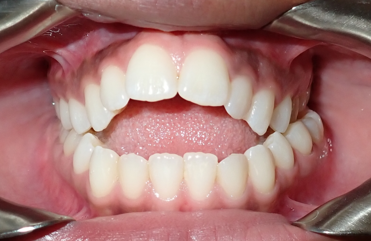 Close-up of a child's open mouth showing upper and lower teeth, with dental tools at the sides.