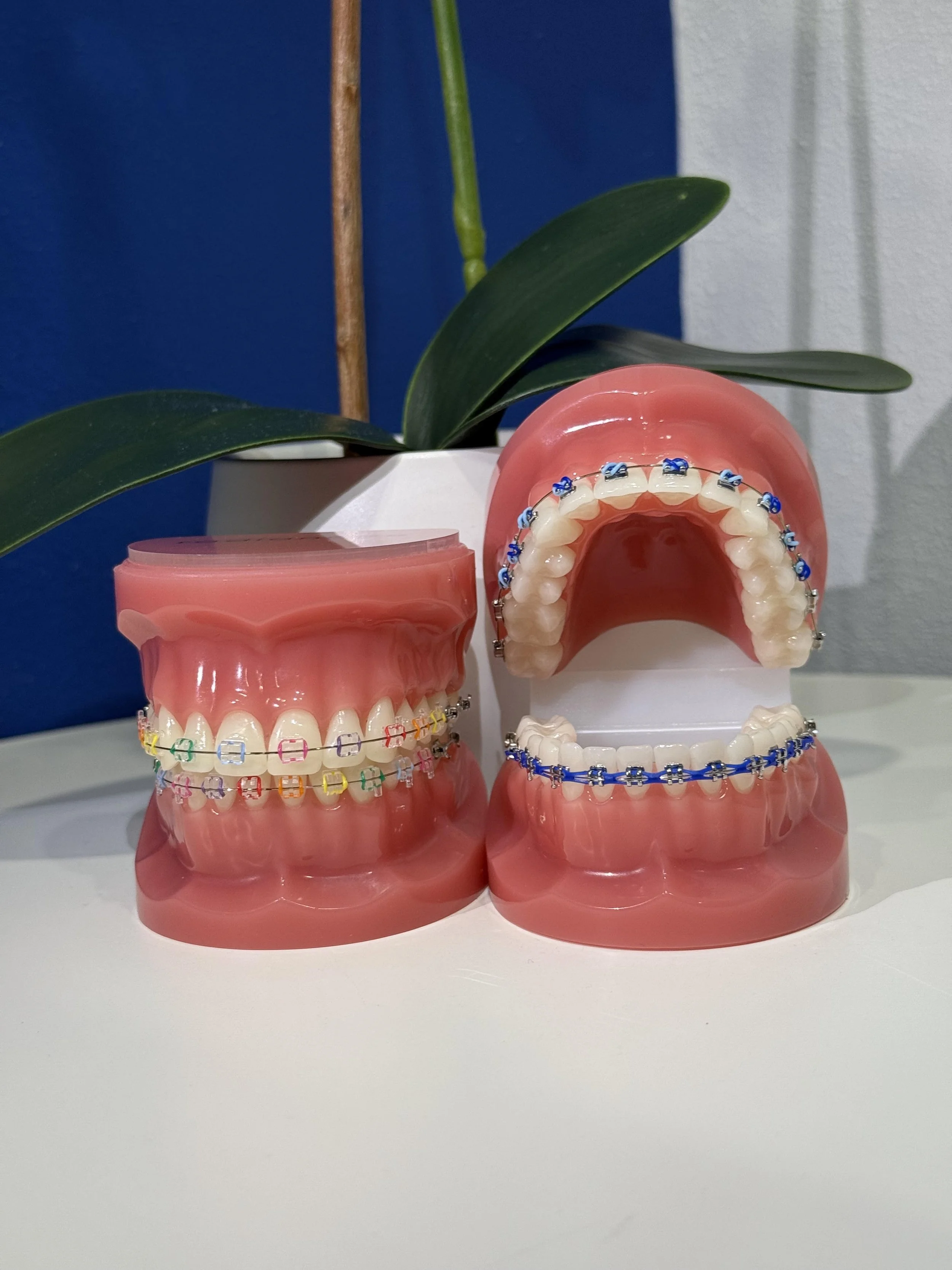 Two dental models with braces on teeth, placed on a white surface. One model is a closed mouth and the other is open, showing the upper teeth with braces. There is a green plant with large leaves in the background.