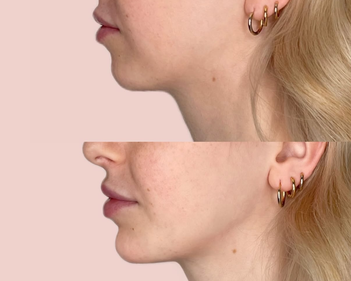 Side-by-side comparison photo of a woman's profile, showing improved chin and jawline in the after image, with gold hoop earrings and blonde hair.