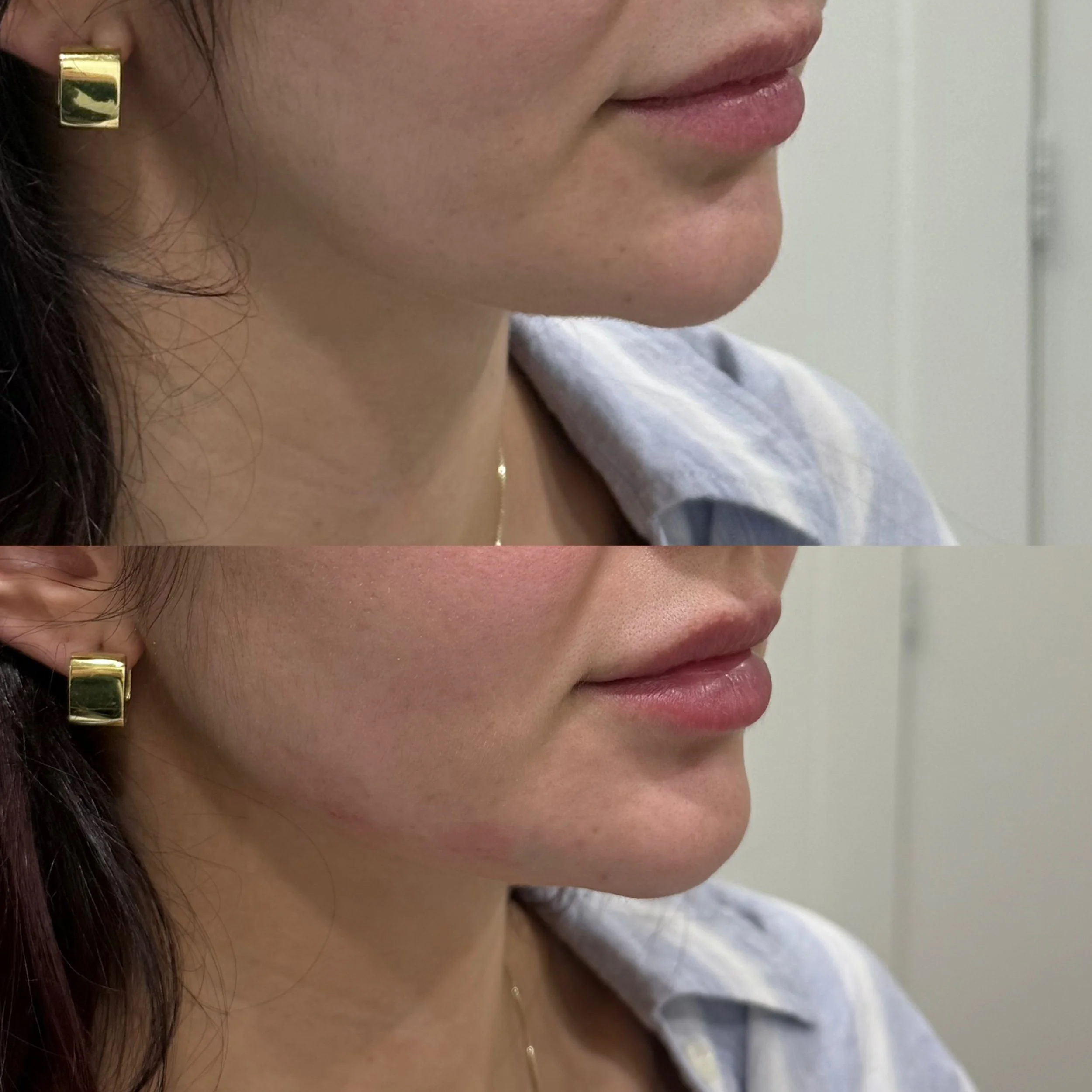 Side-by-side comparison of a woman's chin and jaw before and after filler cosmetic lip enhancement, showing fuller lips in the after photo.