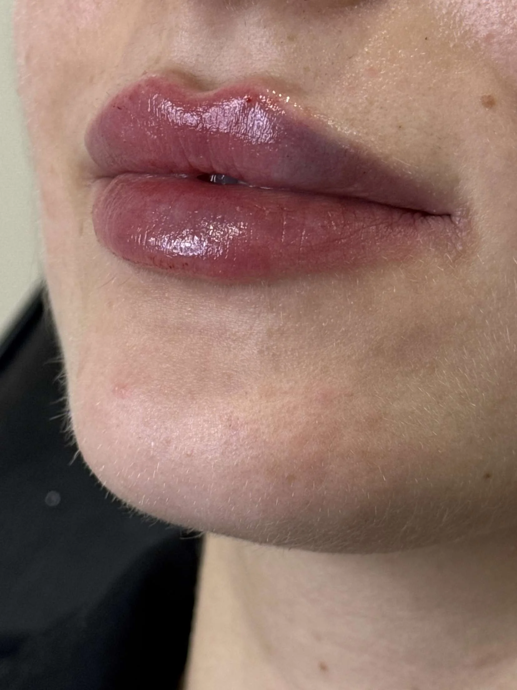 Close-up of a person's lips after lip filler with glossy, pinkish-brown lipstick.