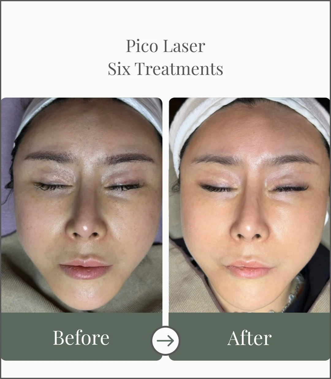 Side-by-side comparison photo showing a woman's face before and after six Pico Laser treatments, with close-up of her face and closed eyes.
