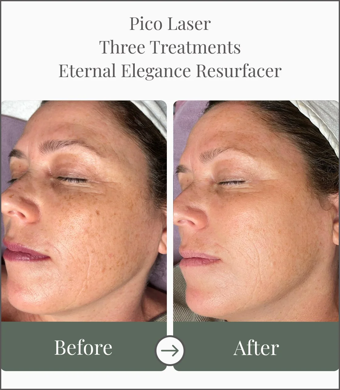 Comparison of a woman's face before and after three Pico Laser treatments, showing improvement in skin pigmentation and texture.