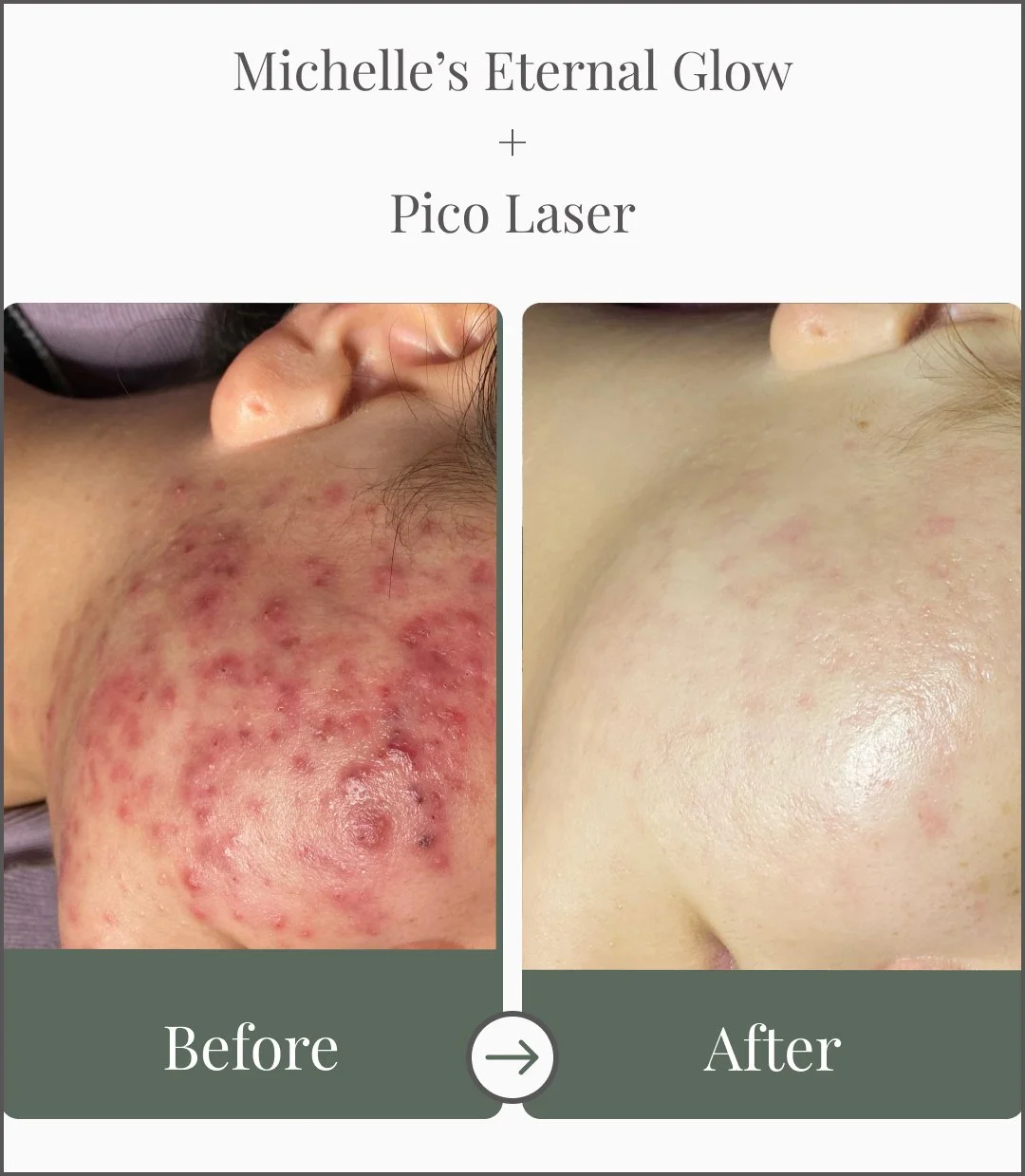 Comparison of facial skin before and after laser treatment, showing significant reduction in acne and redness.