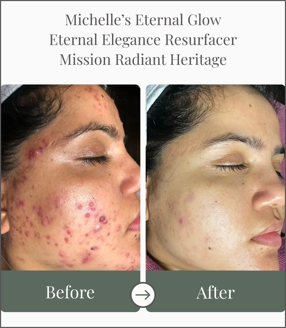Side-by-side comparison of a woman's face showing acne before and after treatment, with the left side labeled 'Before' and the right side labeled 'After'.