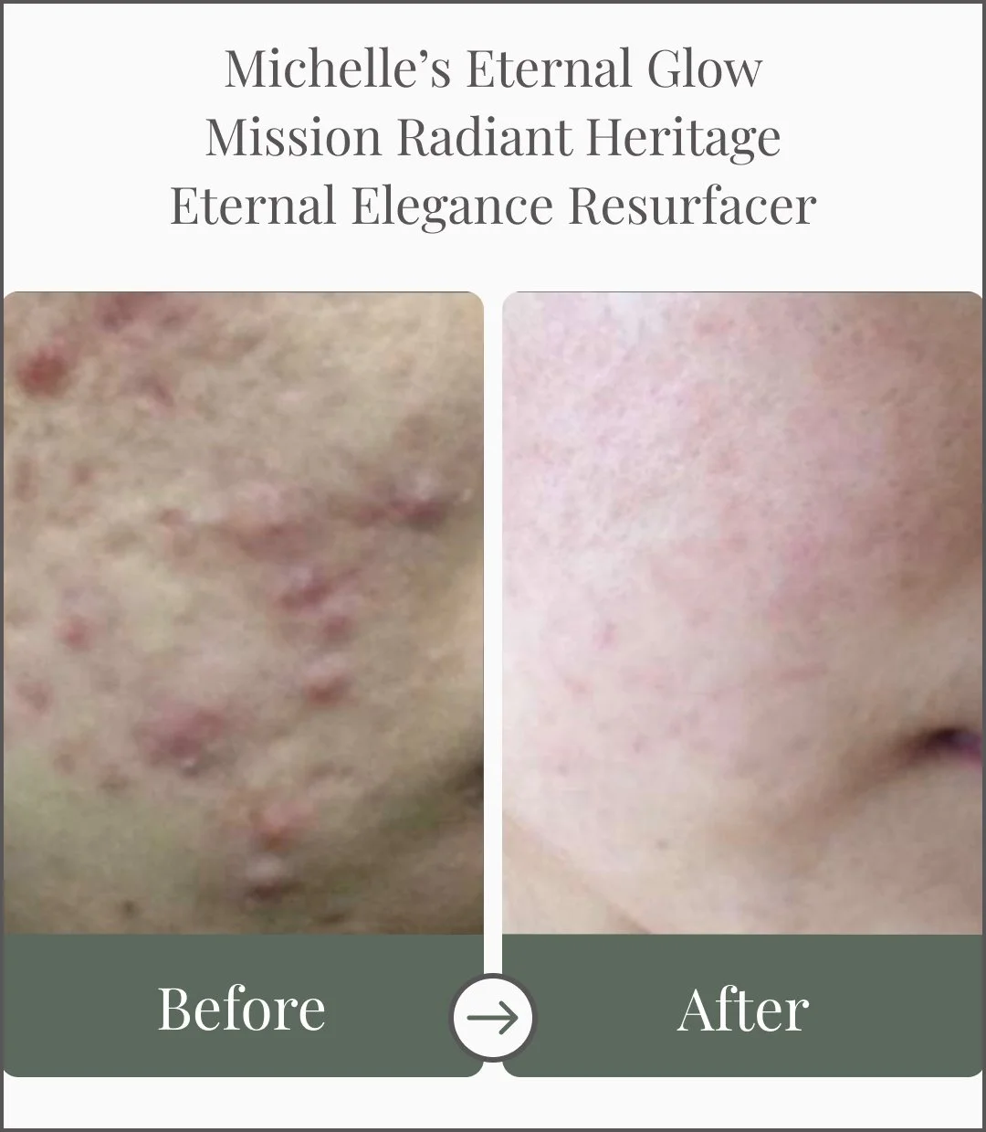 Close-up of a person's skin showing a significant reduction in acne, scars, and redness in the 'after' photo compared to the 'before' photo, demonstrating skin improvement.