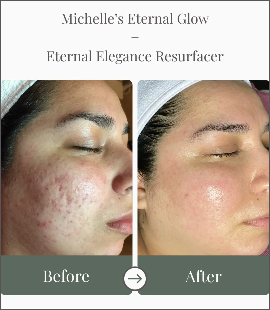 Side-by-side comparison of a person's face before and after skincare treatment, showing improved skin texture and reduced acne scars.