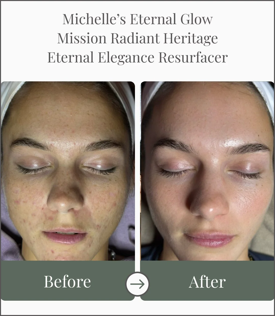 Comparison of a woman's face before and after skincare treatment, showing reduced acne and clear skin in the after photo.