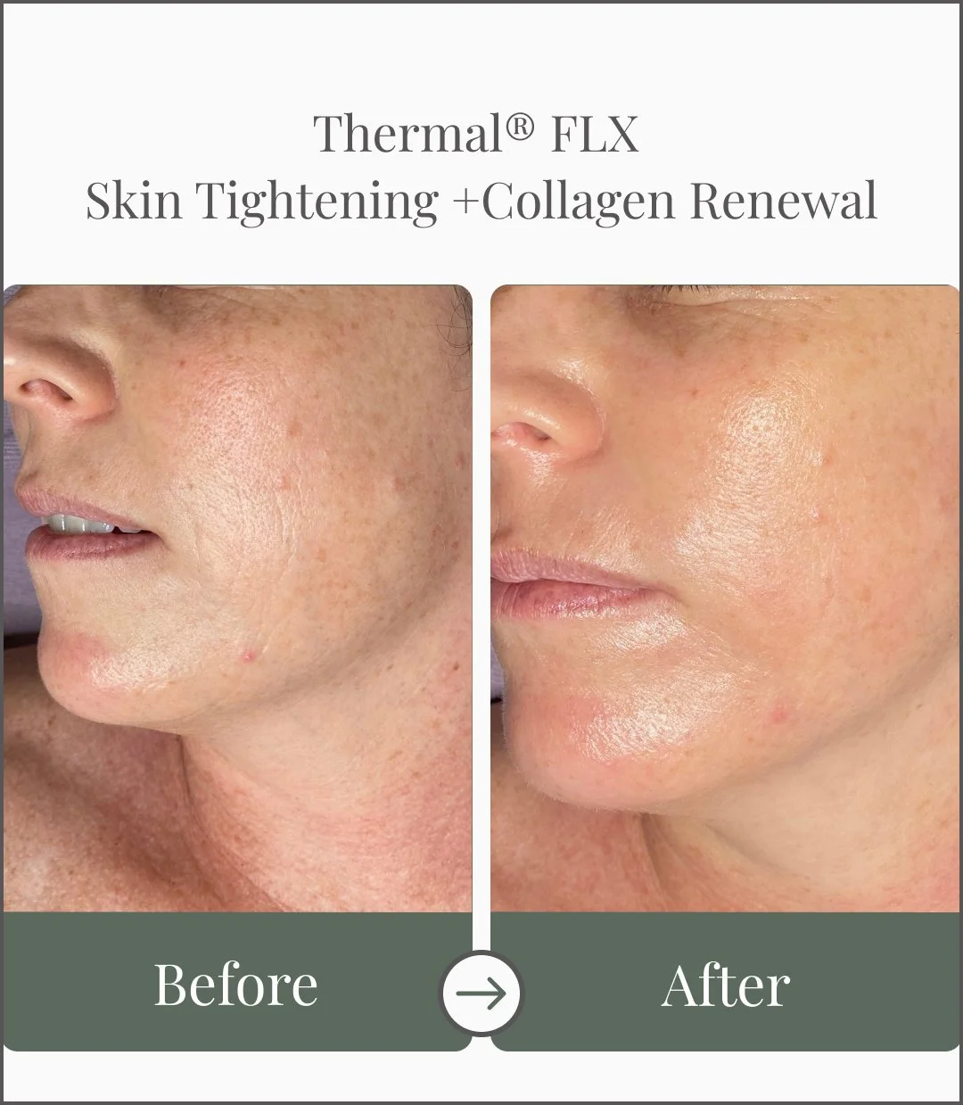 Side-by-side comparison of a woman's face before and after a skin treatment, showing improved skin tightness and collagen renewal, with text indicating 'Thermal® FLX Skin Tightening + Collagen Renewal' and 'Before' on the left and 'After' on the righ