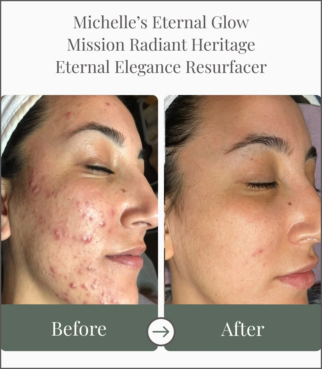 Side view of a woman's face showing a before and after comparison of skin improvement. The left side displays acne and scars, while the right side shows clearer, smoother skin.