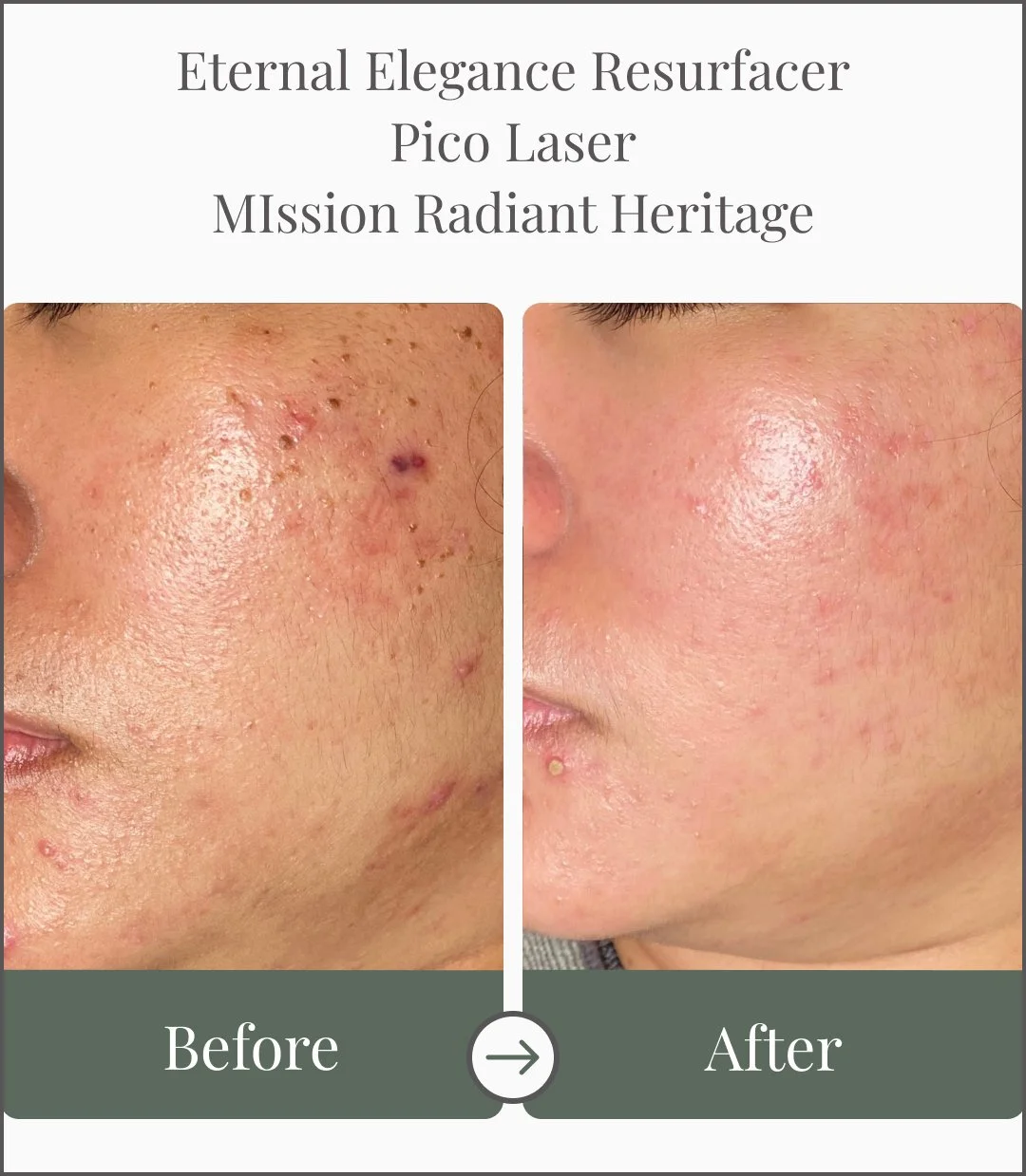 Side-by-side comparison of a person's cheek showing significant reduction in acne scars and skin blemishes after laser treatment; before on the left with visible scars and pimples, after on the right with smoother skin