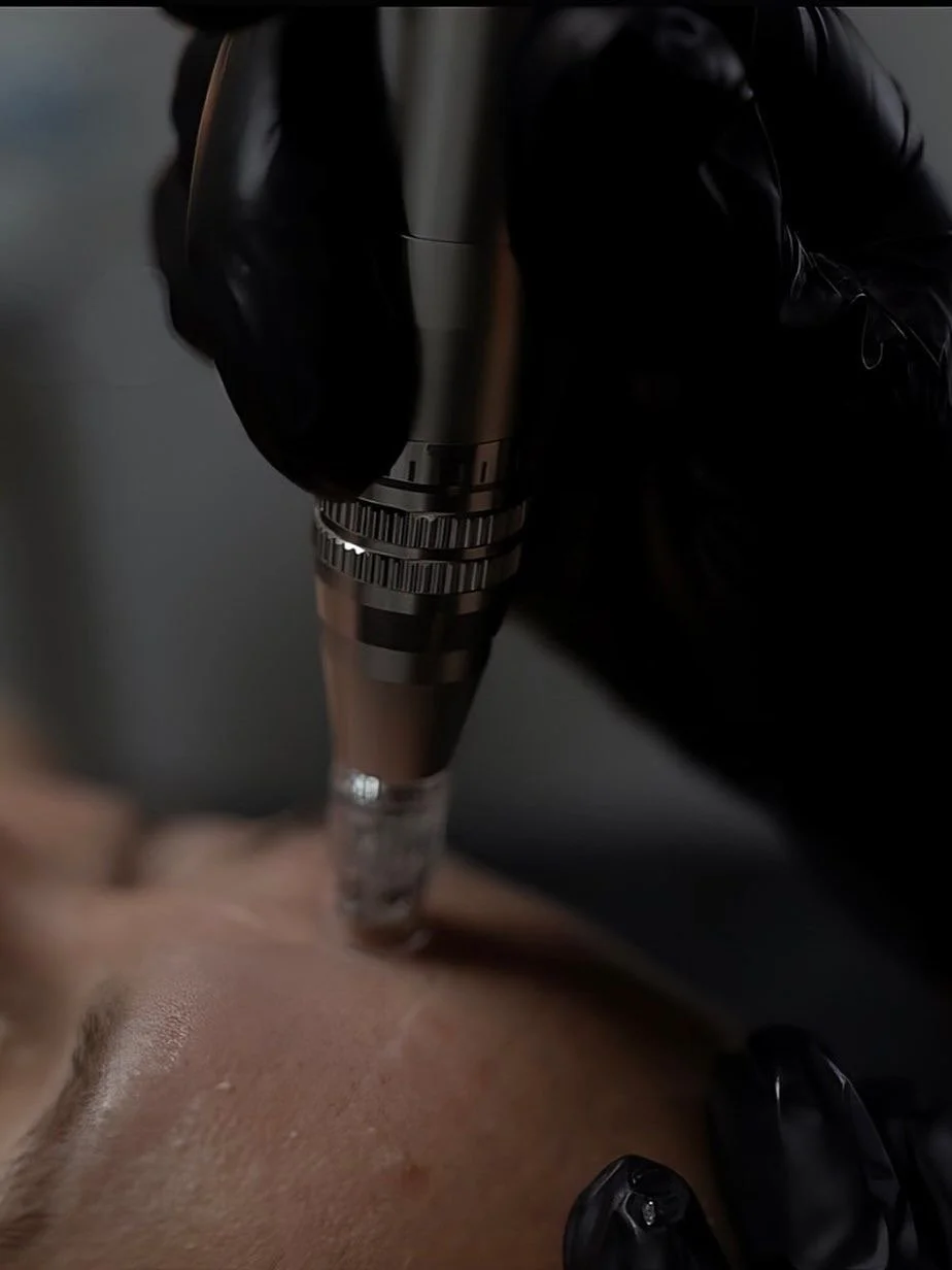 MICRONEEDLING