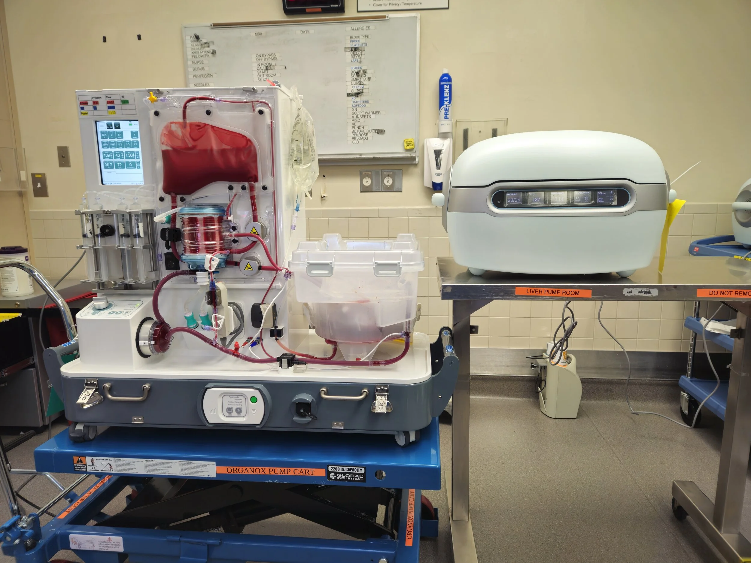 Medical equipment setup with a dialysis machine on the left and a liver pump on the right on a hospital table, in a clinical room with a whiteboard in the background.