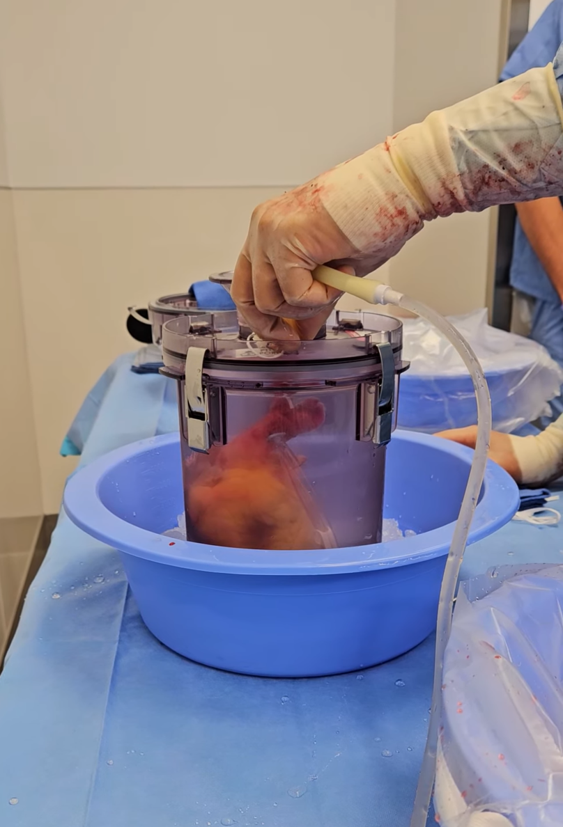 Medical professional handling a sample inside a sterile container during a surgical procedure.