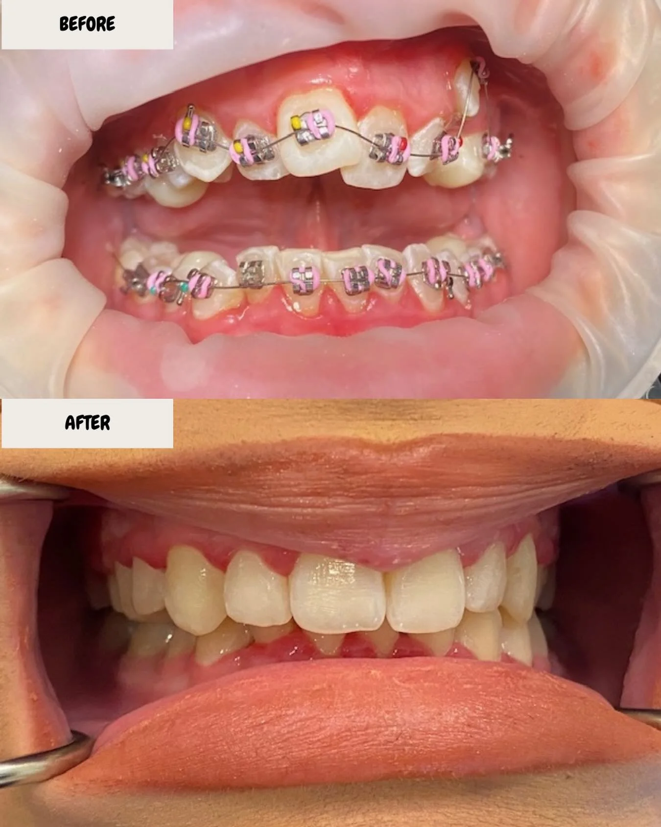 Braces off, confidence on ✨🦷

From crowding and alignment concerns to a balanced, healthy smile &mdash; this transformation is why we love what we do. Orthodontic treatment isn&rsquo;t just about aesthetics, it improves function, hygiene, and long-t