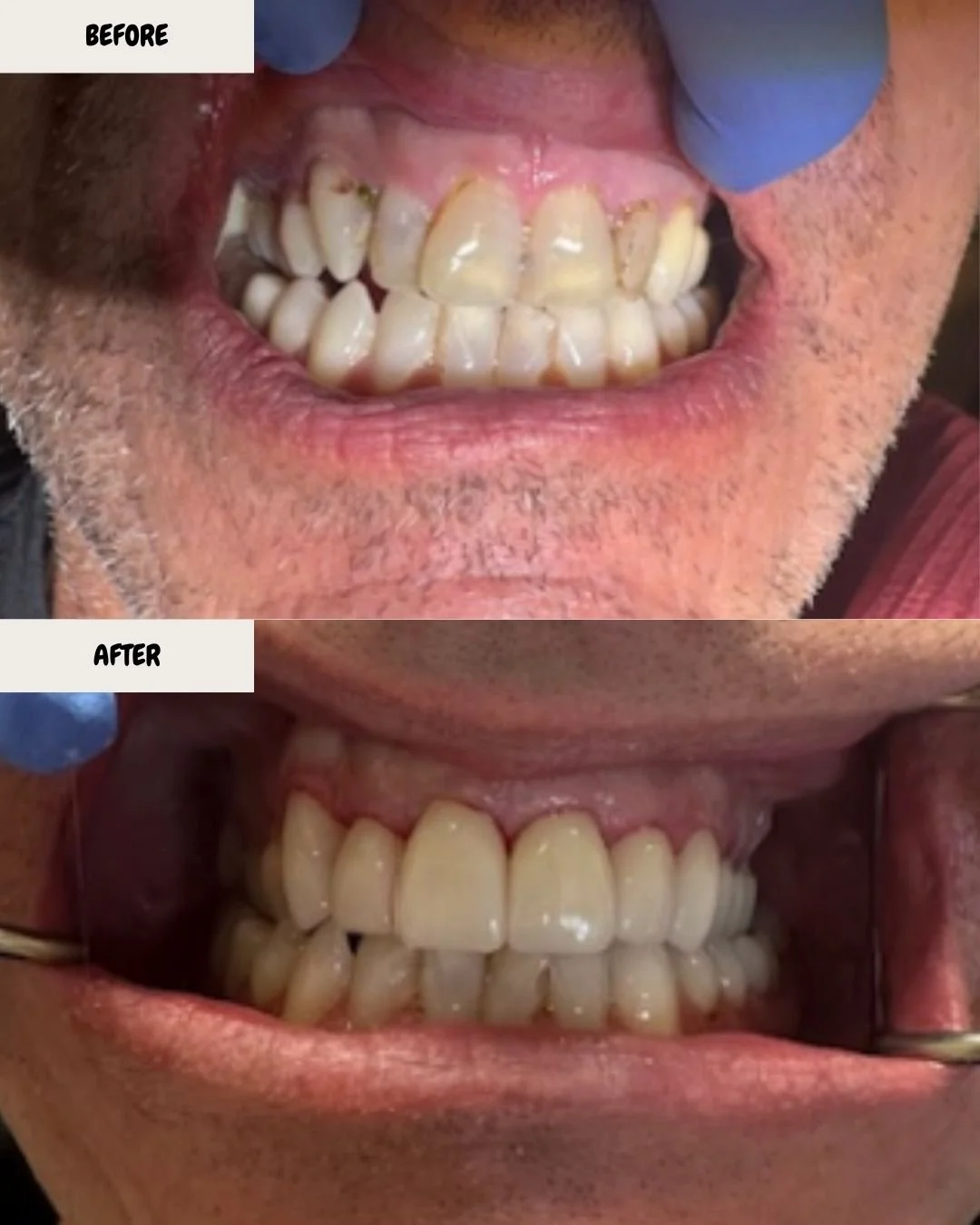 From stained and crowded to clean, aligned, and confident ✨🦷

A smile transformation that speaks for itself &mdash; healthier gums, brighter teeth, and a natural finish.

Porcelain crowns designed for strength, function, and a natural aesthetic &mda