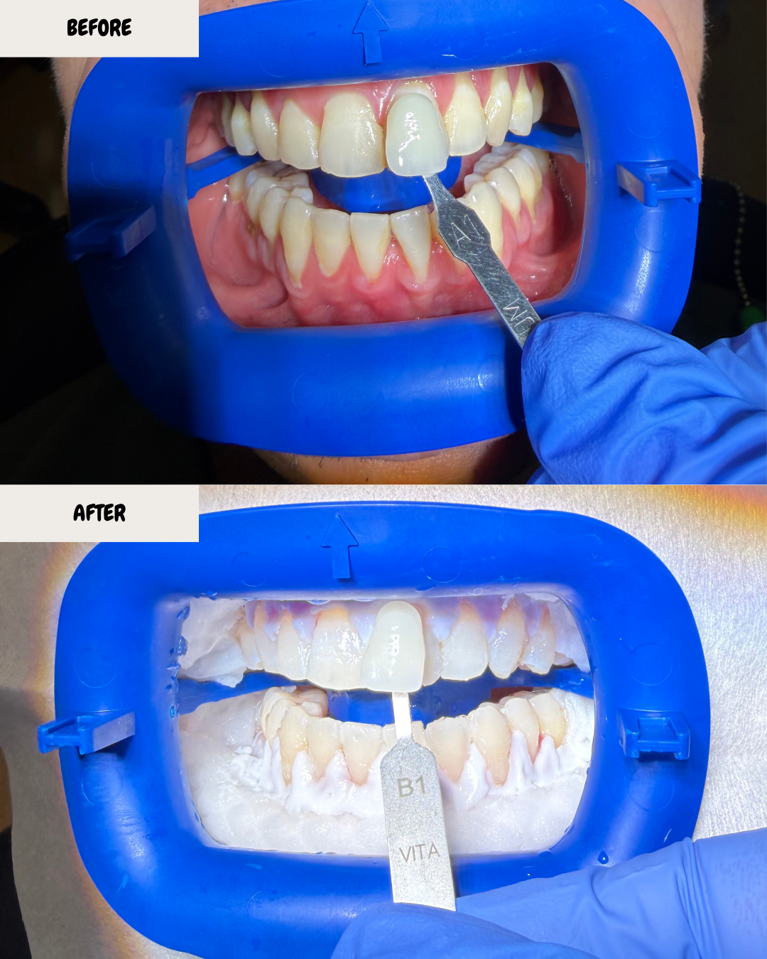 Close-up of a person's teeth and gums in a dental tray before and after teeth whitening treatment, with dental tools and a gloved hand visible.
