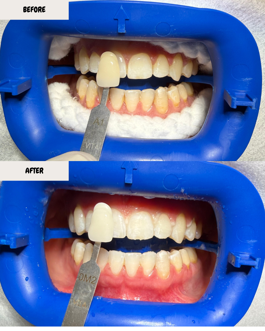 Before and after images of a dental procedure showing a person's teeth with a dental shade guide. In the before image, the teeth are discolored and a dental veneer is being prepared for placement. In the after image, a new, whiter dental veneer is ap