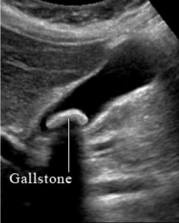 Private Abdominal Ultrasound in Portsmouth and Warsash In Hampshire: What It Can and Can’t Detect