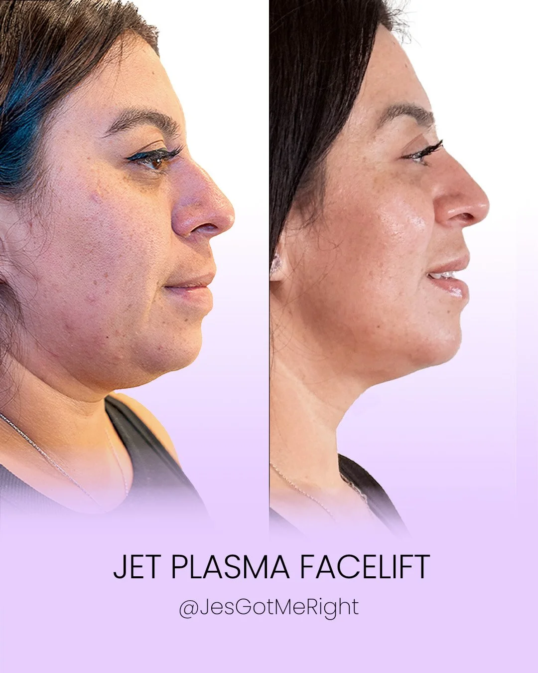Jet plasma facelift before and after showing improved skin firmness and tighter jawline without surgery in Malibu