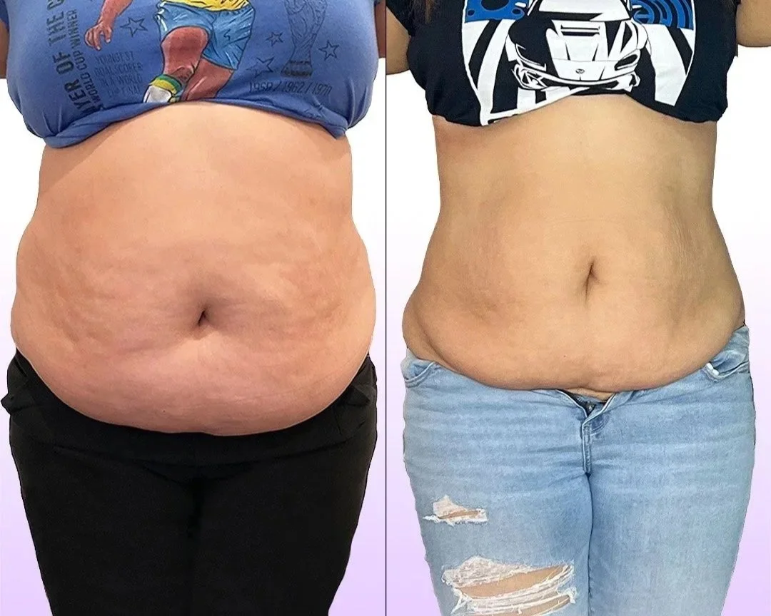 Noninvasive Tummy Tuck before and after client results with noninvasive fat loss treatment with Jes Got Me Right