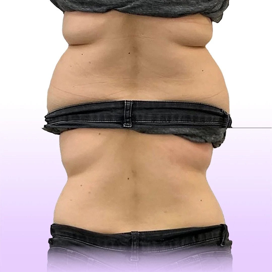 Back and Bra Roll Reduction before and after showing smooth back and hourglass waistline without surgery in Los Angeles.