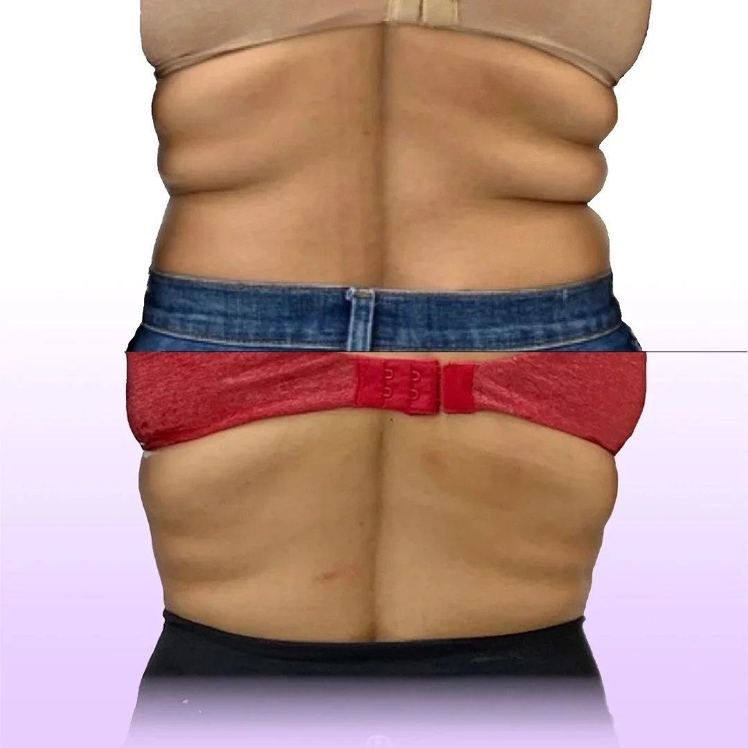 Back and Bra Roll Reduction before and after showing tightened back without surgery in the waistline