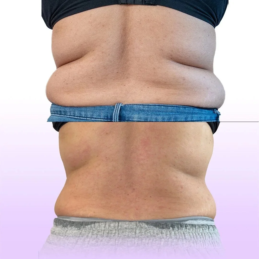 Back and bra roll elimination before and after showing cinched waistline without surgery for a defined hourglass shape