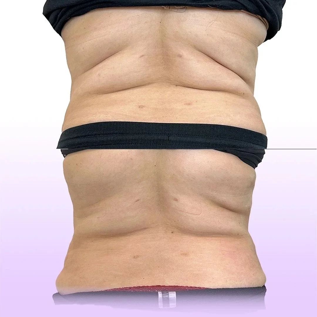 Back and Bra Roll Reduction before and after showing post lipo swelling reduction without the need for surgery 