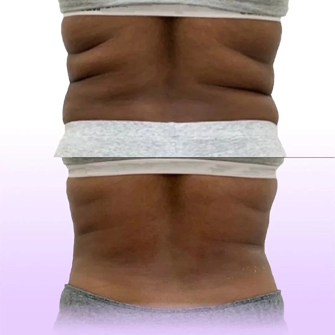 Back and Bra Roll reduction before and after showing reduced back rolls without surgery along the back line
