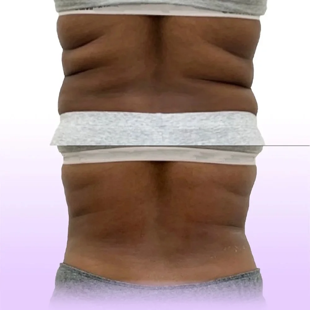 Back roll reduction before and after
