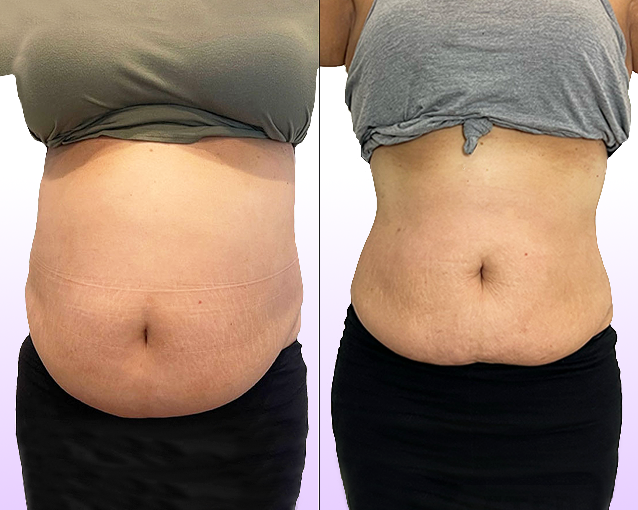The Noninvasive Tummy Tuck treatment before and after showing lifted and reduced waistline without surgery in entire abdomen
