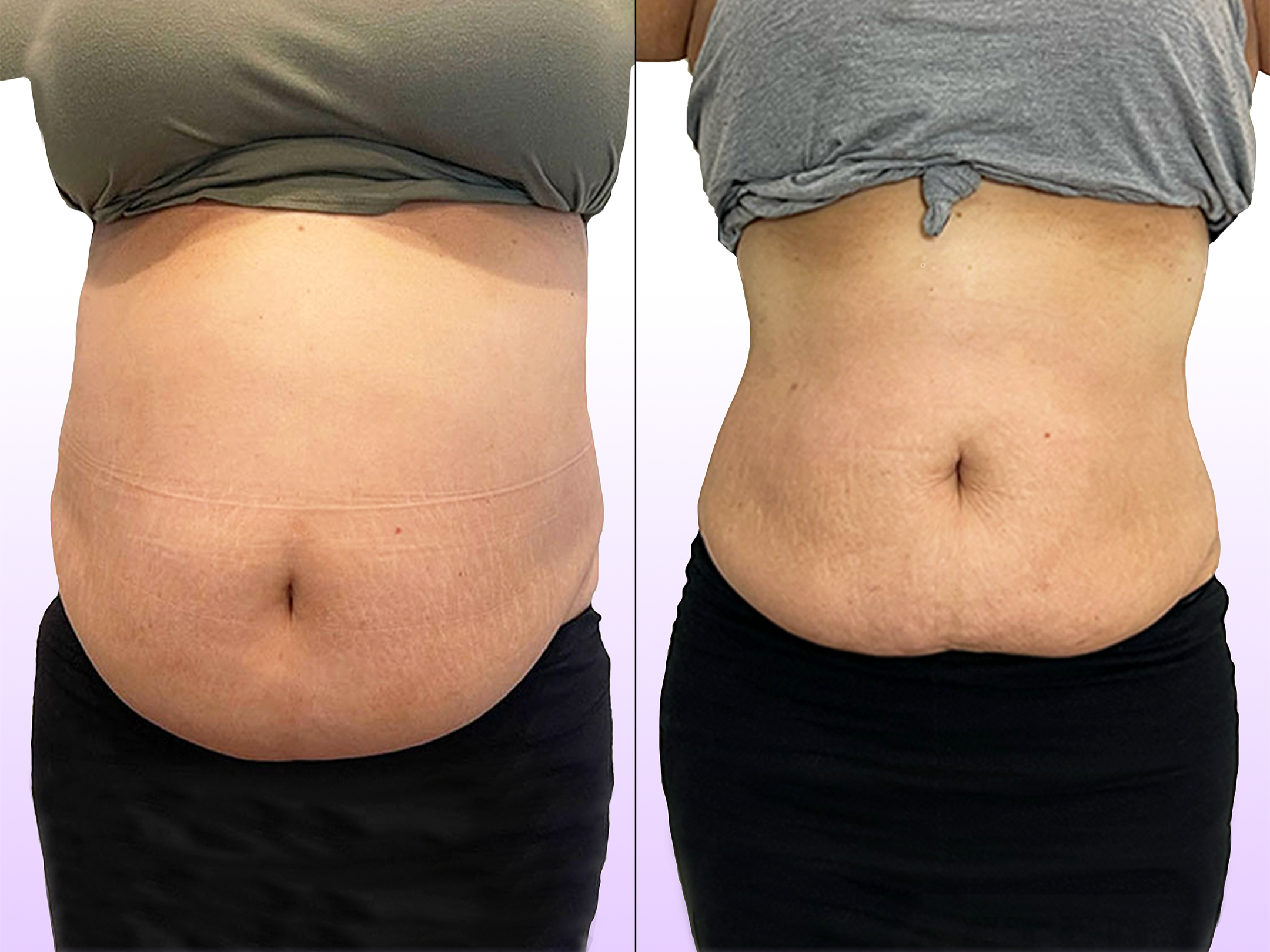 The Noninvasive Tummy Tuck treatment before and after showing lifted and reduced waistline without surgery in entire abdomen