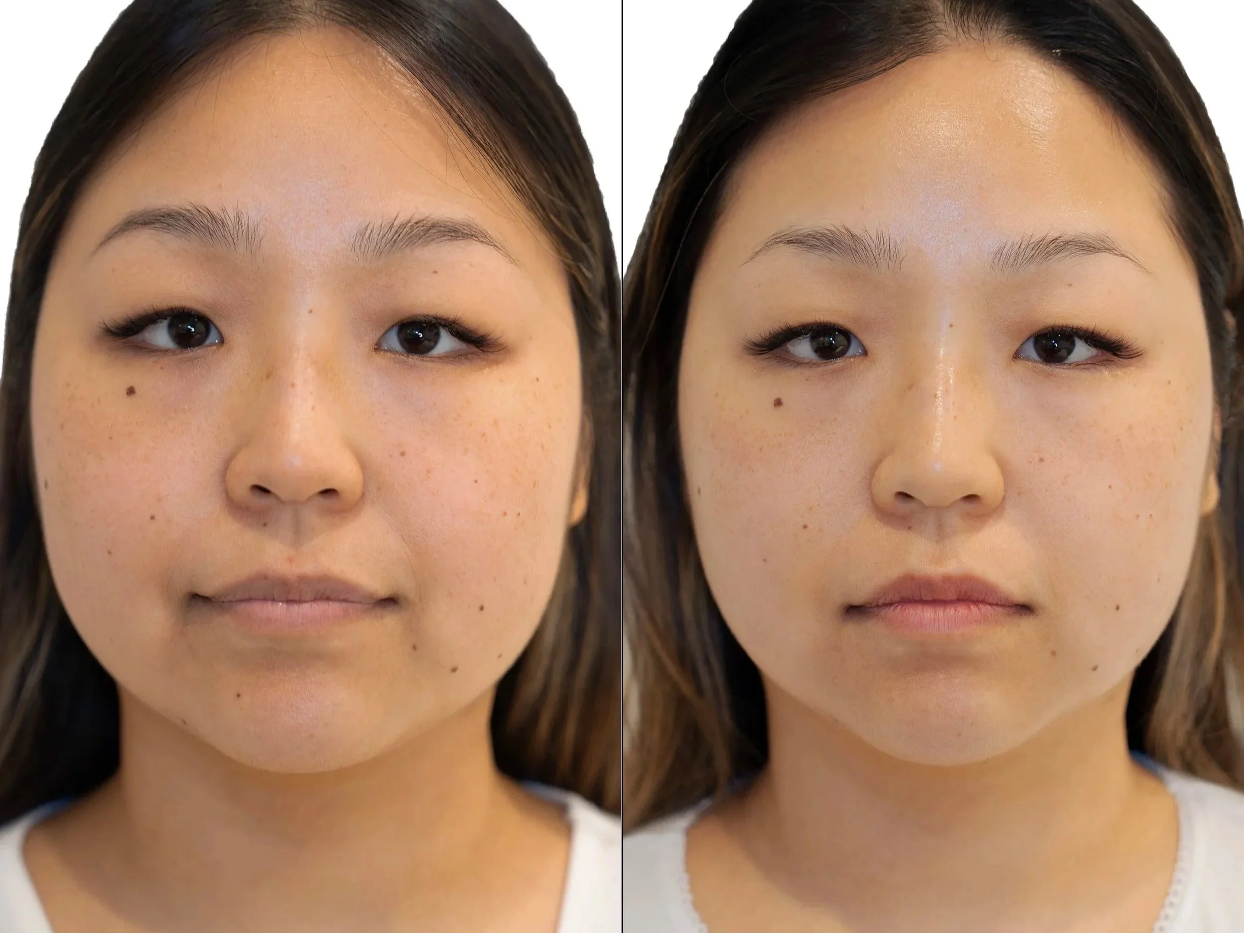 Jet Plasma Facelift before and after showing reduced puffiness and jawline slimming without surgery for aging face