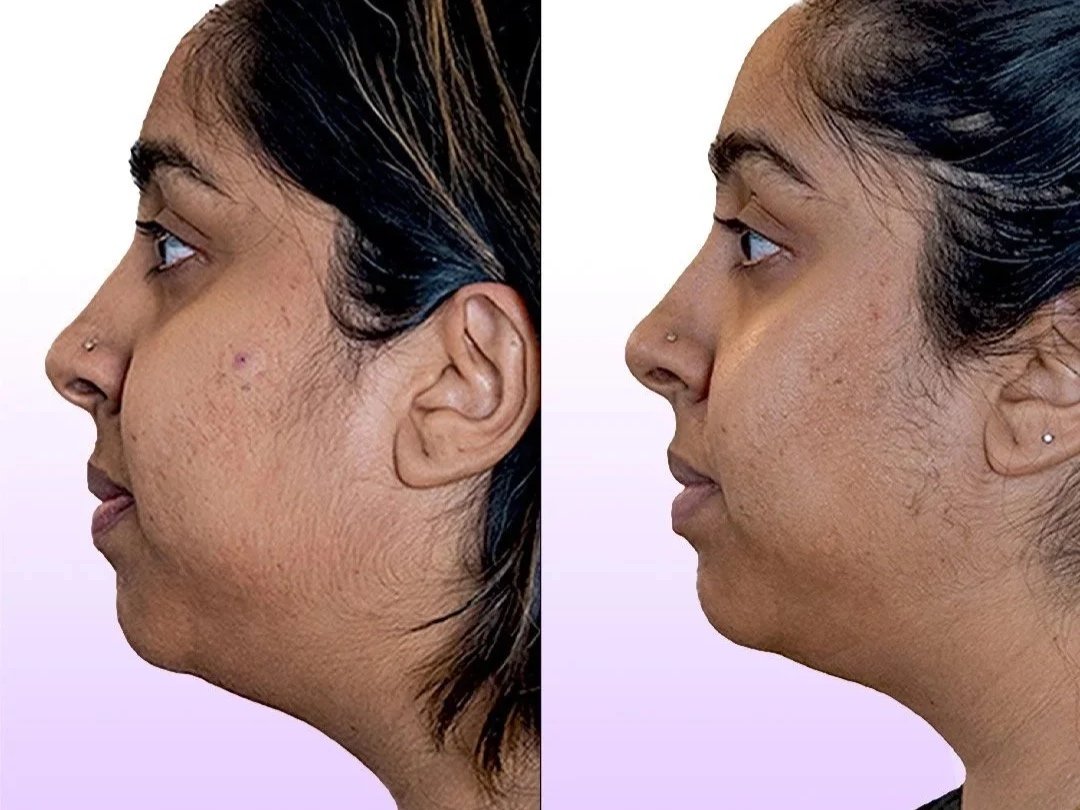 Jet Plasma Facelift before and after showing acne scars reduction and chin lift without surgery or injections in Santa Clarita