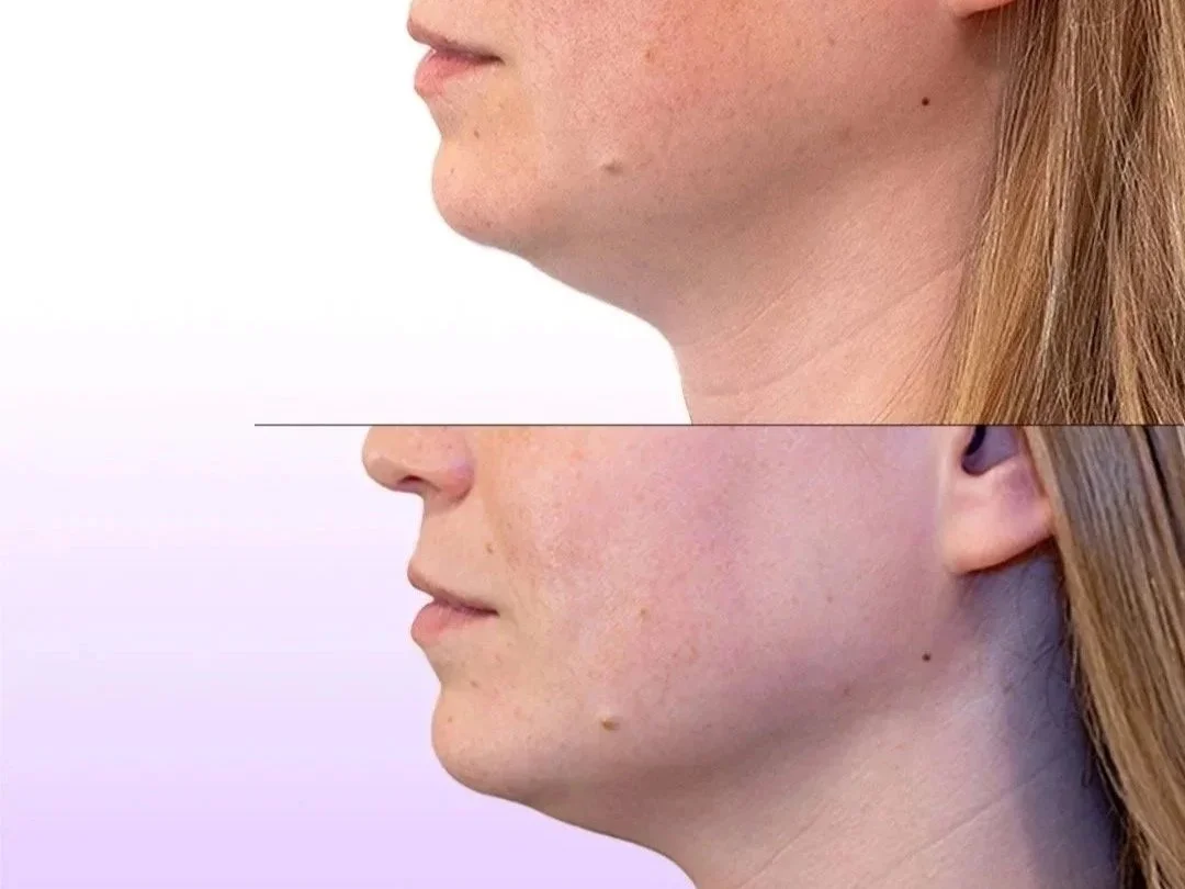 Jet Plasma Facelift before and after showing slimmed jawline and skin smoothing without surgery for jawline and chin
