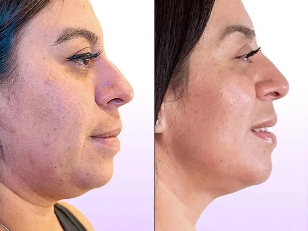 Jet Plasma Facelift before and after showing reduced acne scars and lightened hyperpigmentation with skin tightening without surgery in the jawline and face