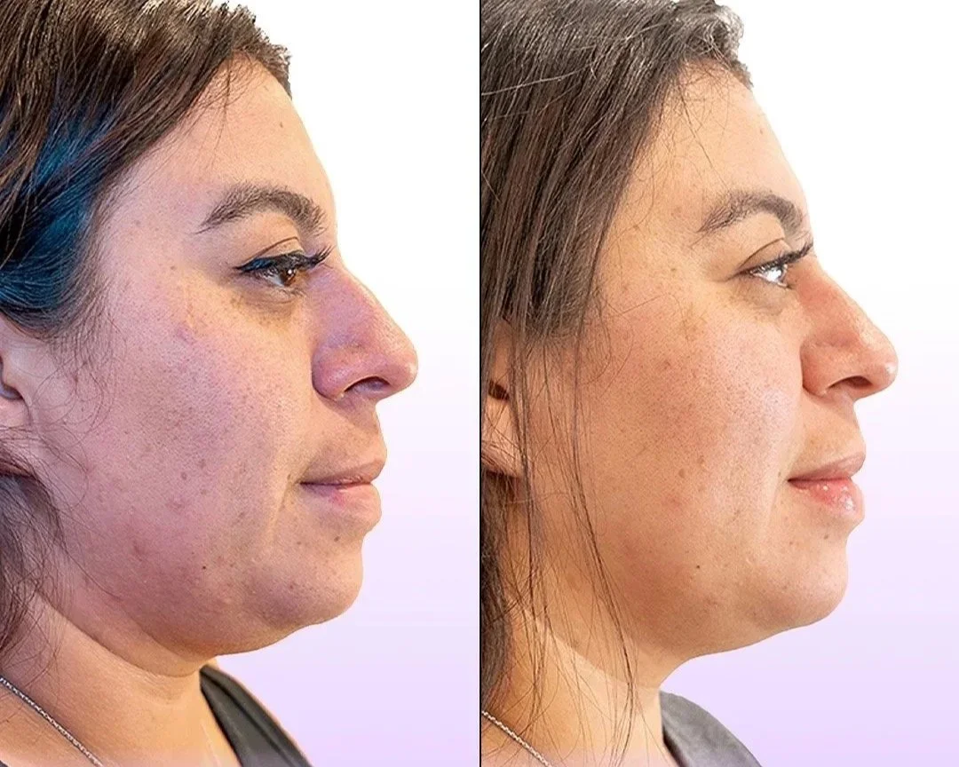 Jet Plasma Facelift before and after showing reduced acne scars and lightened hyperpigmentation with skin tightening without surgery in the jawline and face