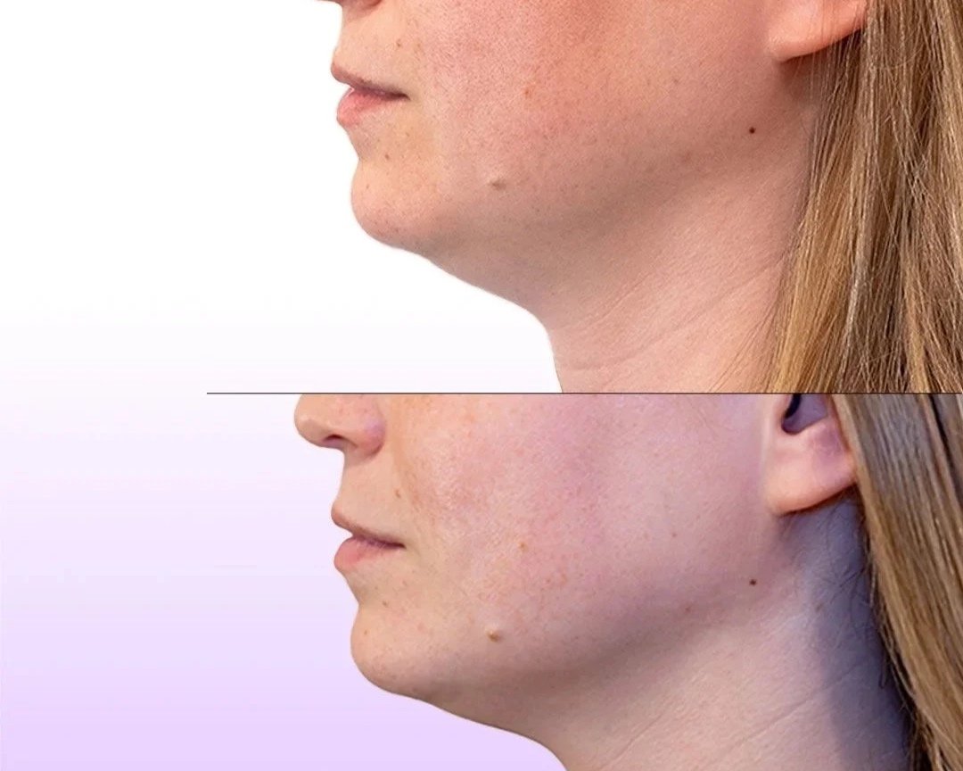 Jet Plasma Facelift before and after showing slimmed jawline and skin smoothing without surgery for chin