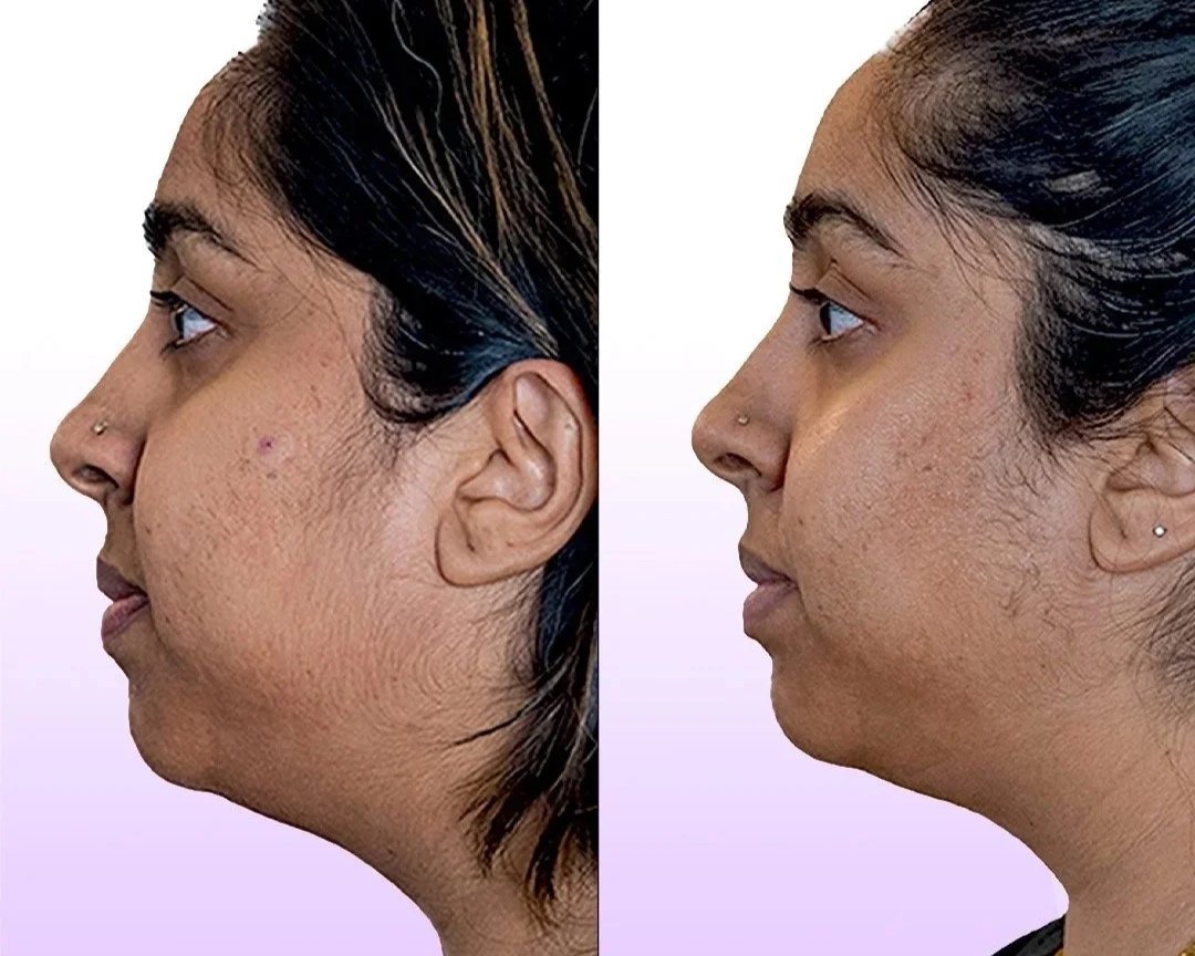 Jet Plasma Facelift before and after showing acne scars reduction and chin lift without surgery or injections for face 