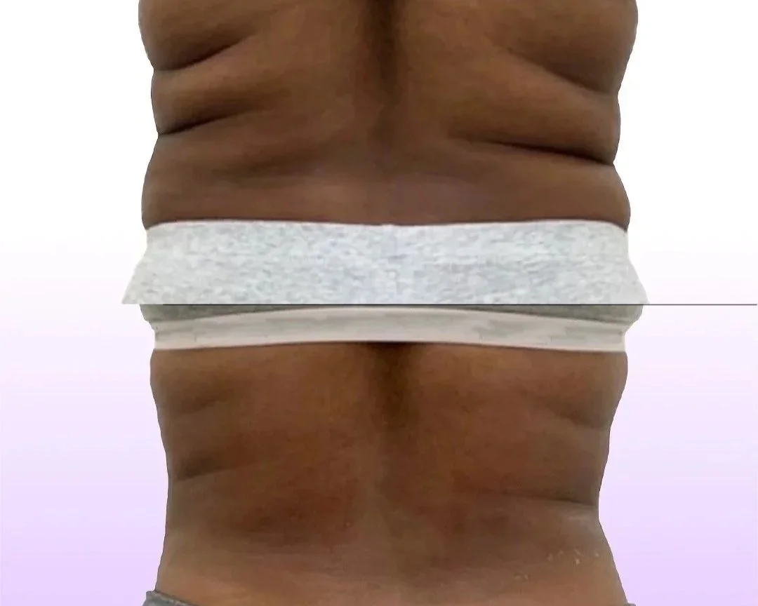 Back and Bra Roll Reduction before and after showing smooth back and hourglass waistline without surgery for back