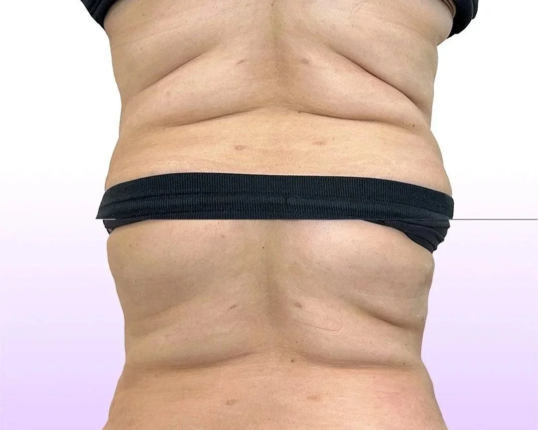 Back and Bra Roll Reduction before and after showing post lipo swelling reduction without surgery in midsection