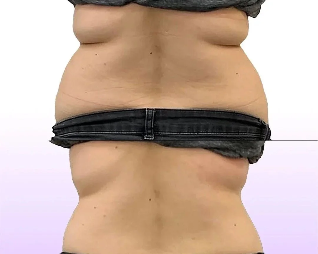 Back and Bra Roll Reduction before and after showing slimmed back without surgery for waistline