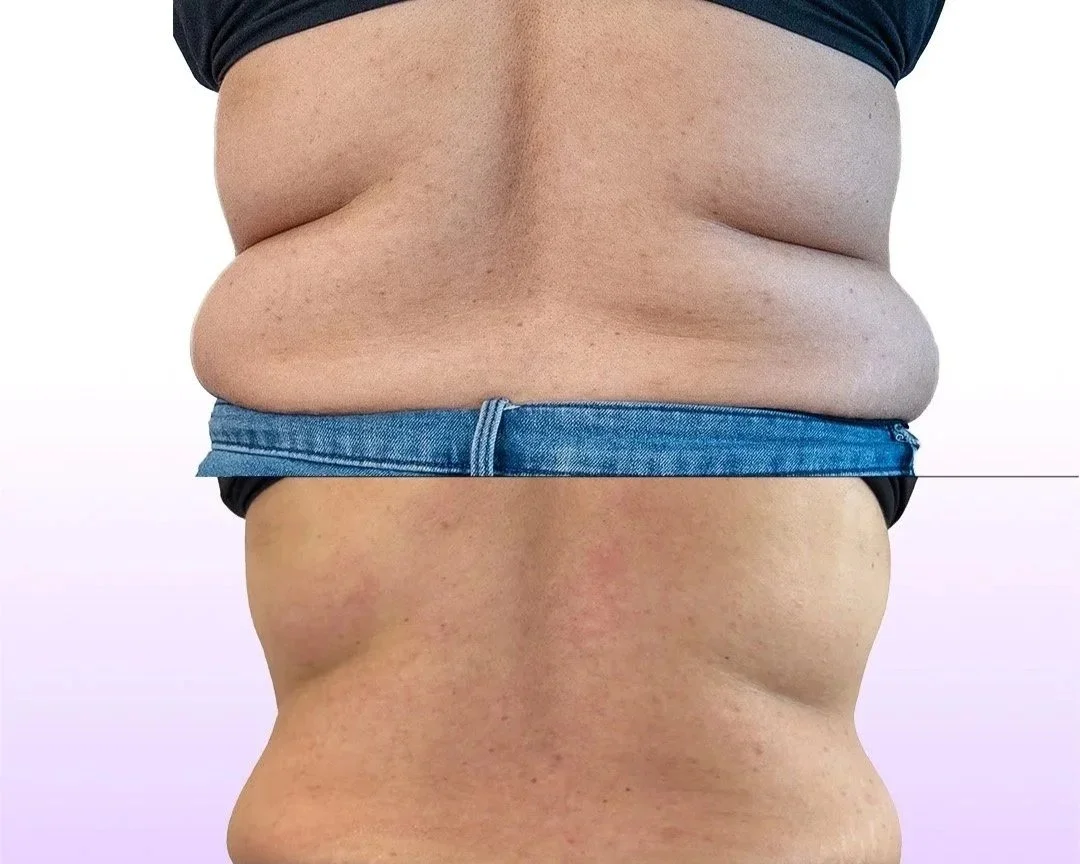 Back and bra roll reduction before and after 3 sessions showing smoothed back and defined waistline with Jes Got Me Right services