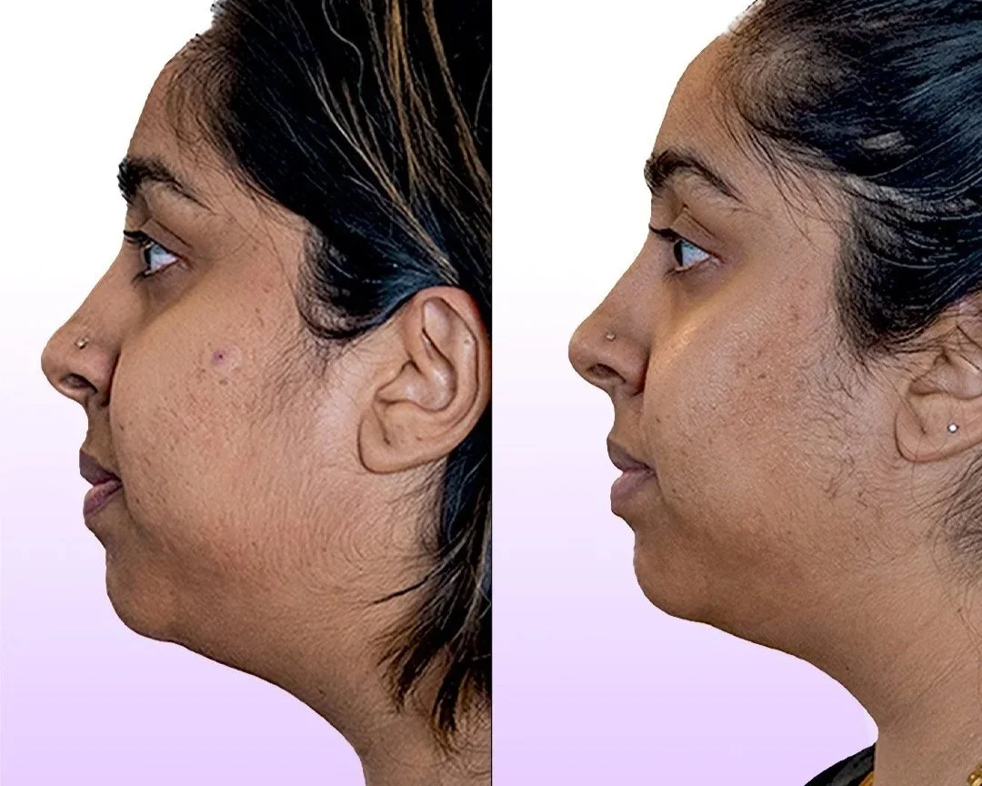 Jet Plasma Facelift before and after result showing reduced acne scarring, tightened and defined chin and neck with Jes Got Me Right treatments
