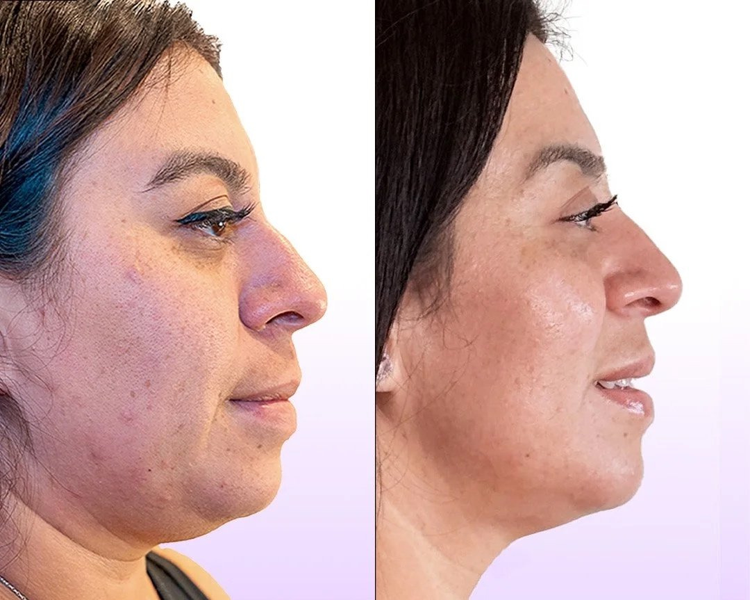 Jet Plasma Facelift before and after showing tightened skin, smooth acne scars, and lifted jawline without surgery in Los Angeles