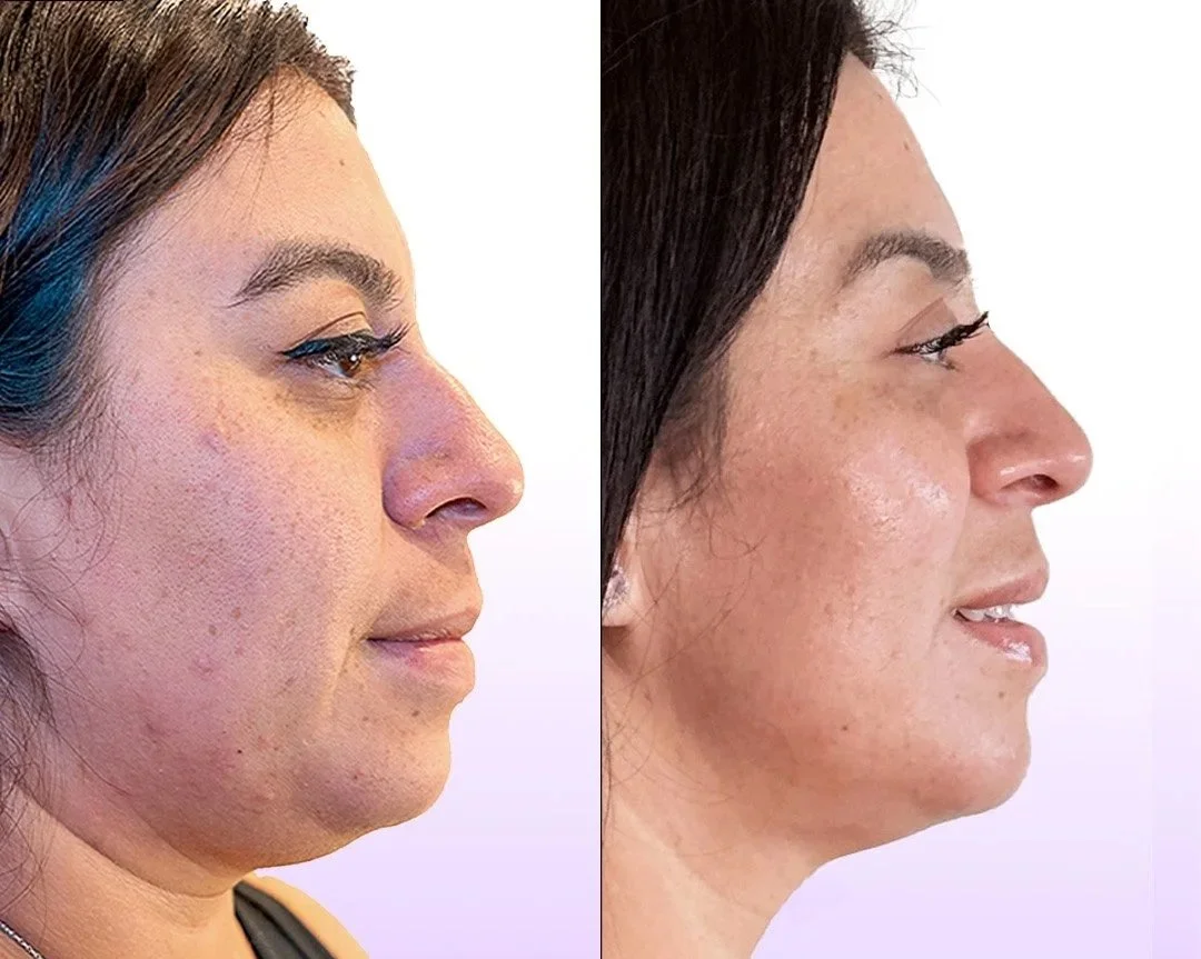 Jet Plasma facial skin-tightening client result